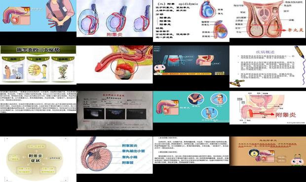 汕头附睾炎症状