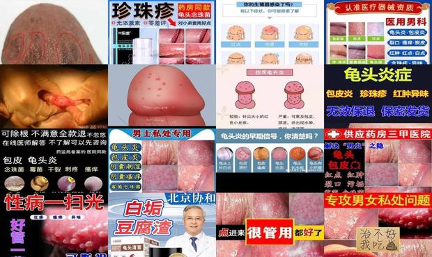 汕头白色念珠菌龟头炎症状