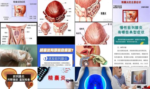 汕头精囊炎症状表现有哪些