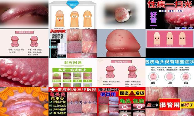 汕头包皮炎症状对照图片