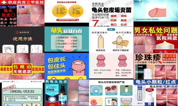 汕头包皮炎症