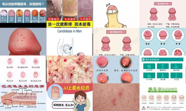 汕头龟头炎症状图片大*