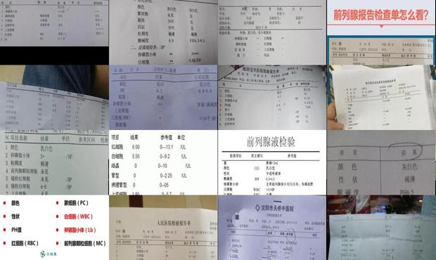 汕头前列腺液检查正常标准
