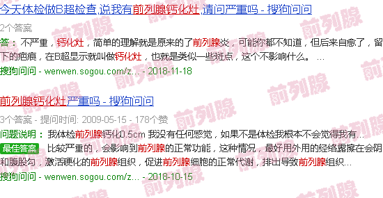 汕头前列腺内钙化灶要紧吗